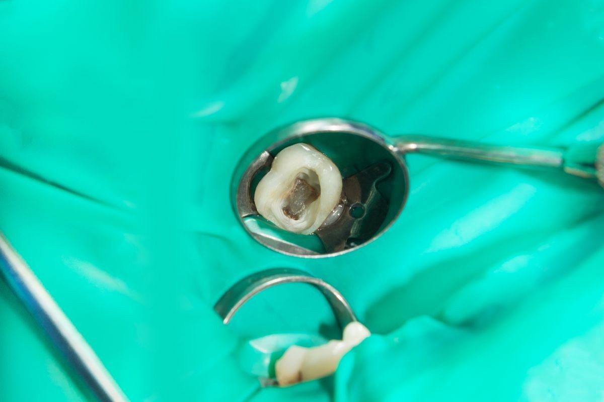 endodontic treatment of teeth close-up. Cleaning of the roots of the teeth and their filling. The concept of modern technology in the dental clinic